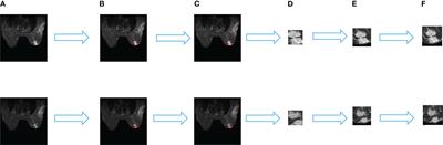 Cross-attention multi-branch CNN using DCE-MRI to classify breast cancer molecular subtypes